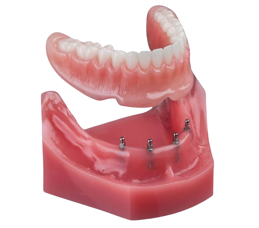 Mini implant dentures